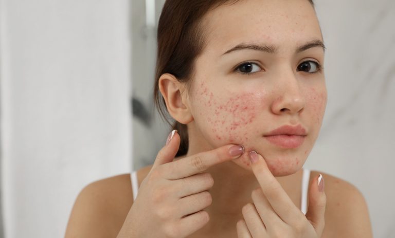 Treatments for Acne-Prone Skin