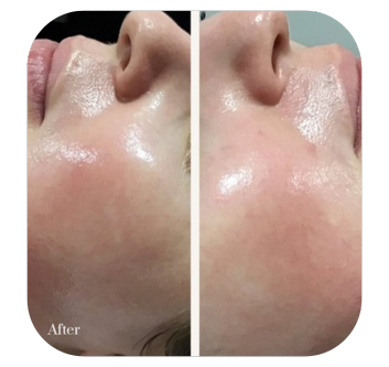 Cosmelan before and after results
